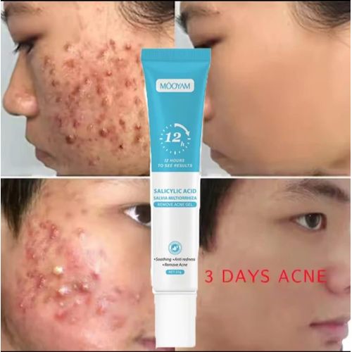 Acne Gel Fast Effective Repair Pimple Scar Anti Spots Removal Gel Smooth Skin Shrink Pores Treatment Cream
