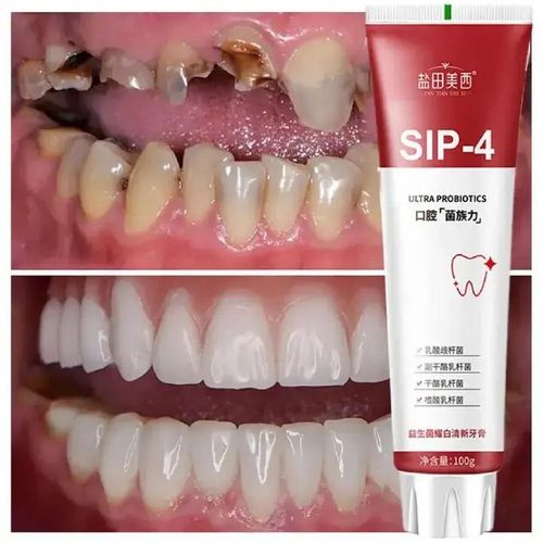 Probiotic Caries Toothpaste Whitening Repair Tooth Decay Paste Cleaner Teeth