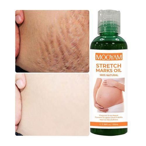 Stretch Mark Removal Oil Scars,Stretch Marks Remover Oil Fade Dark Spots