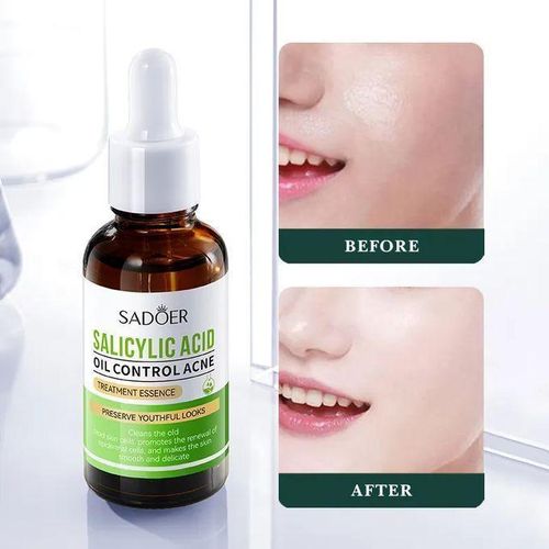 Nourishing Salicylic Acid Serum for Face Shrink Pores Gentle Exfoliating Salicylic Acid for Anti Acne Pimple Spot Blackhead Salicylic Acid Acne Treatment Essence30ml