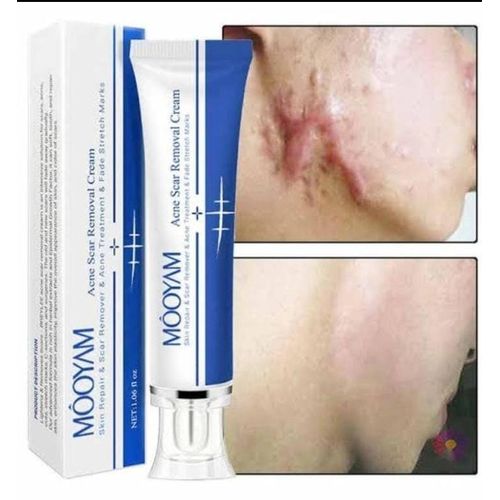 Acne Scar And Stretch Mark Removal Cream