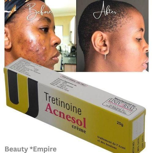 Acnesol Acne Cream 25g - Powerful Acne Treatment for Clearer Smoother Skin