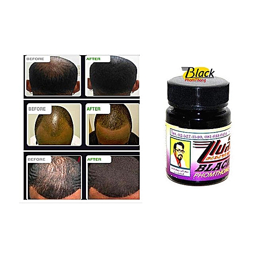 Baldness Hair Loss Treatment
