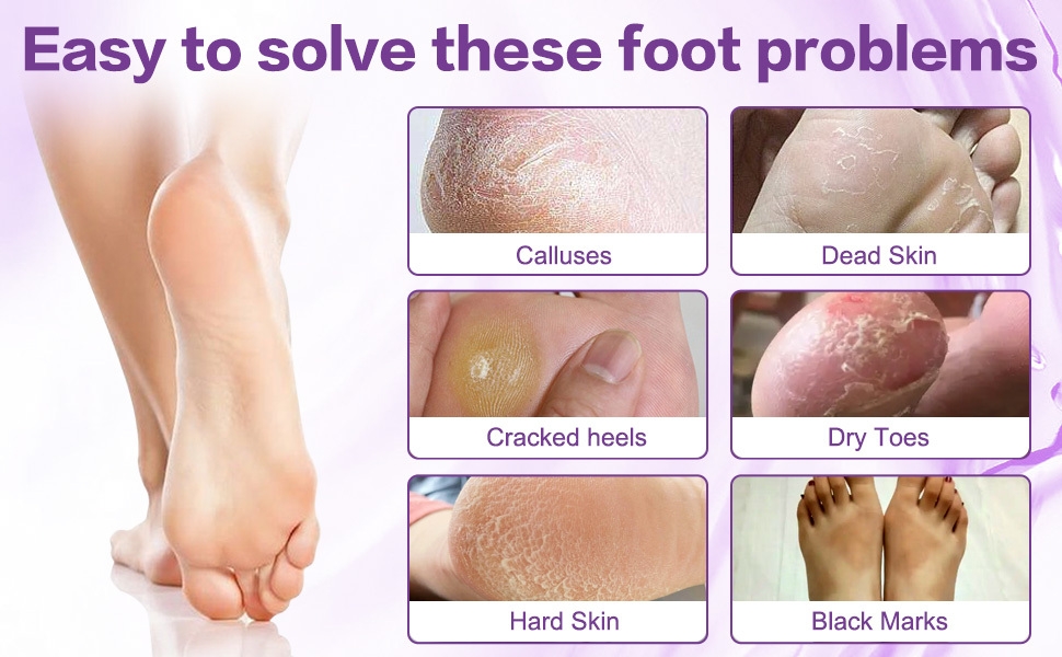 Removes dead skin, calluses, cracked heels, dry toes, black marks, cruelty-free, foot peel off mask