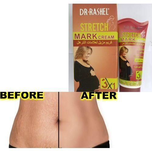 Stretchmark Removal Cream