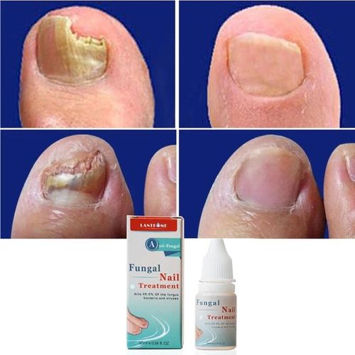 Nail Repair Nail Treatment Nail Fungus Remover Nail Repair Nail Treatment Serum