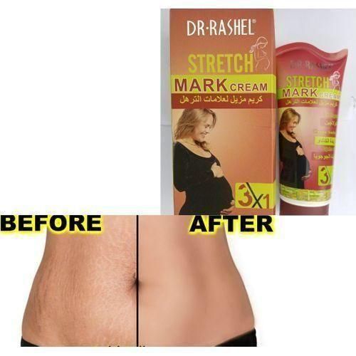 Stretchmark Removal Cream