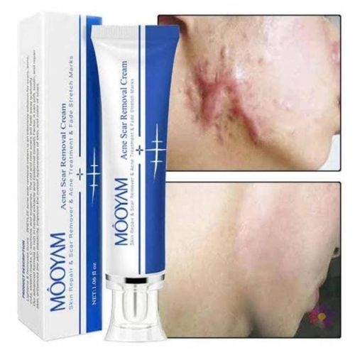 Acne Scar And Stretch Mark Removal Cream