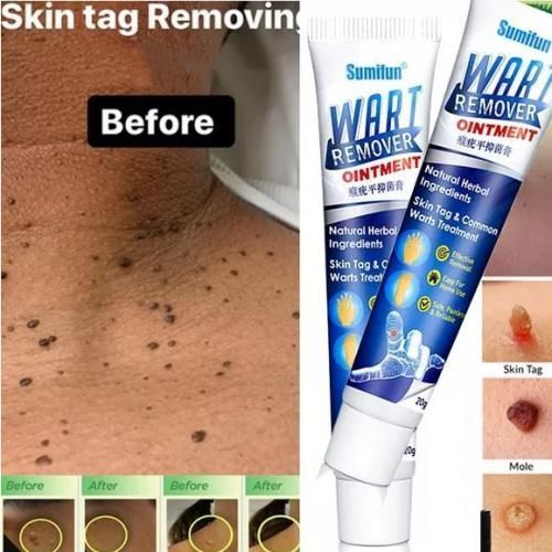Herbal Warts Remover Ointment Mole/skin Tag Treatment Cream
