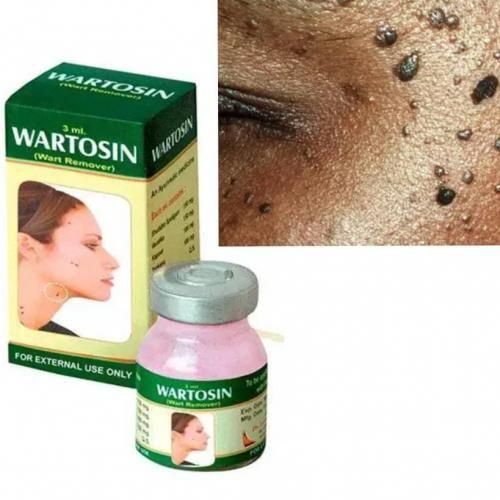 Ayurvedic Warts Remover/Removal Cream Ointment