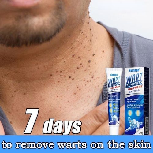 Warts And Moles Remover Cream