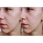 product_image_name-SADOER-SkinCare  for Acne Prone Skin-2