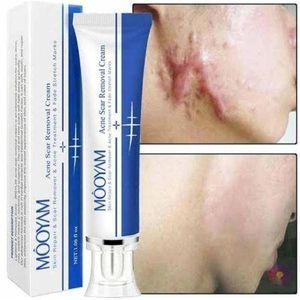 MOOYAM Acne Scar Removal Cream