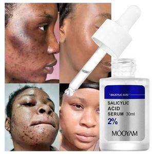 Salicylic Acid Oil Control Dark Spots Remover Acne Remover Blackhead Pimple Removal Salicylic Acid Face Serum