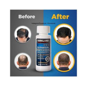 Kirkland Minoxidil 5% Extra Strength Hair Regrowth 1 Month Works