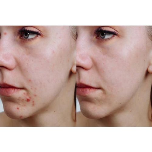 product_image_name-SADOER-SkinCare  for Acne Prone Skin-2