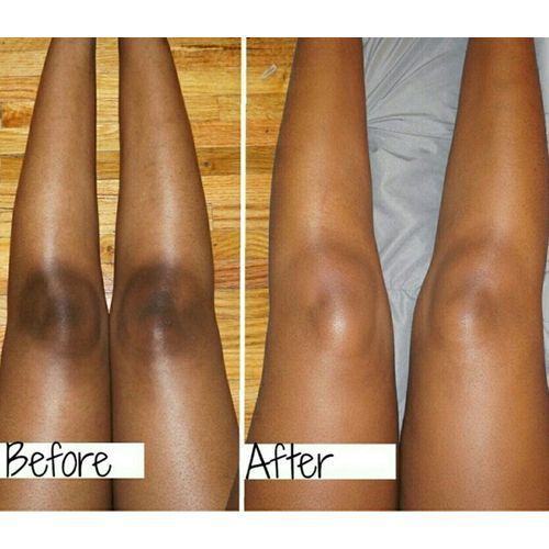 How To Whiten Knees, Scars, And Marks On Legs