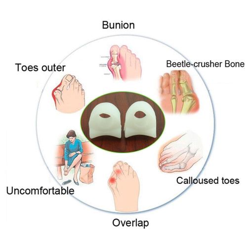 product_image_name-Fashion-2 X Hallux Valgus/Bunion Corrector - Silicone Toe Separator-3