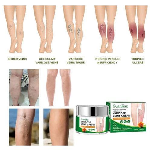 product_image_name-Guanjing-Varicose veins cream -5