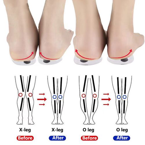 Fashion Orthopedic Insoles For Correcting O X Type Leg Silicone Magnetic Shoe Cushions Knock Knee Bow Legs Best Price Online Jumia Kenya