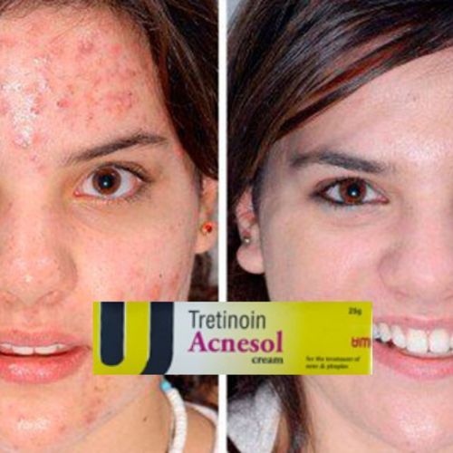 tretinoin cream before and after acne