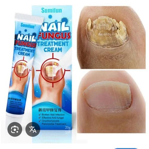 Nail Fungus Treatment Cream Repairs Restores Protects Damaged Nails